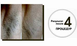 Результат фотоэпиляции после 4 процедур